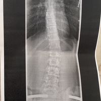 scoliosislife