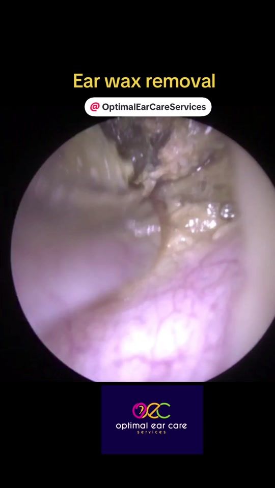 TikTok video thumbnail by optimalearcareservices