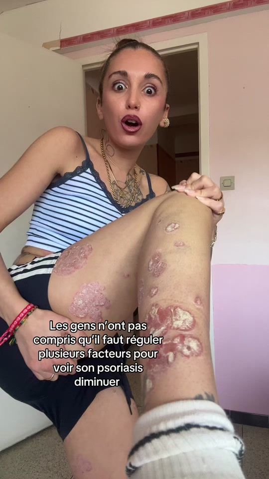 TikTok video thumbnail by lyla_psoriasistyle