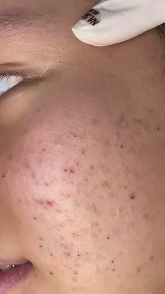 TikTok video thumbnail by pimple.concep